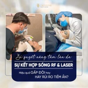 ket-hop-song-rf-va-laser-tai-pristine