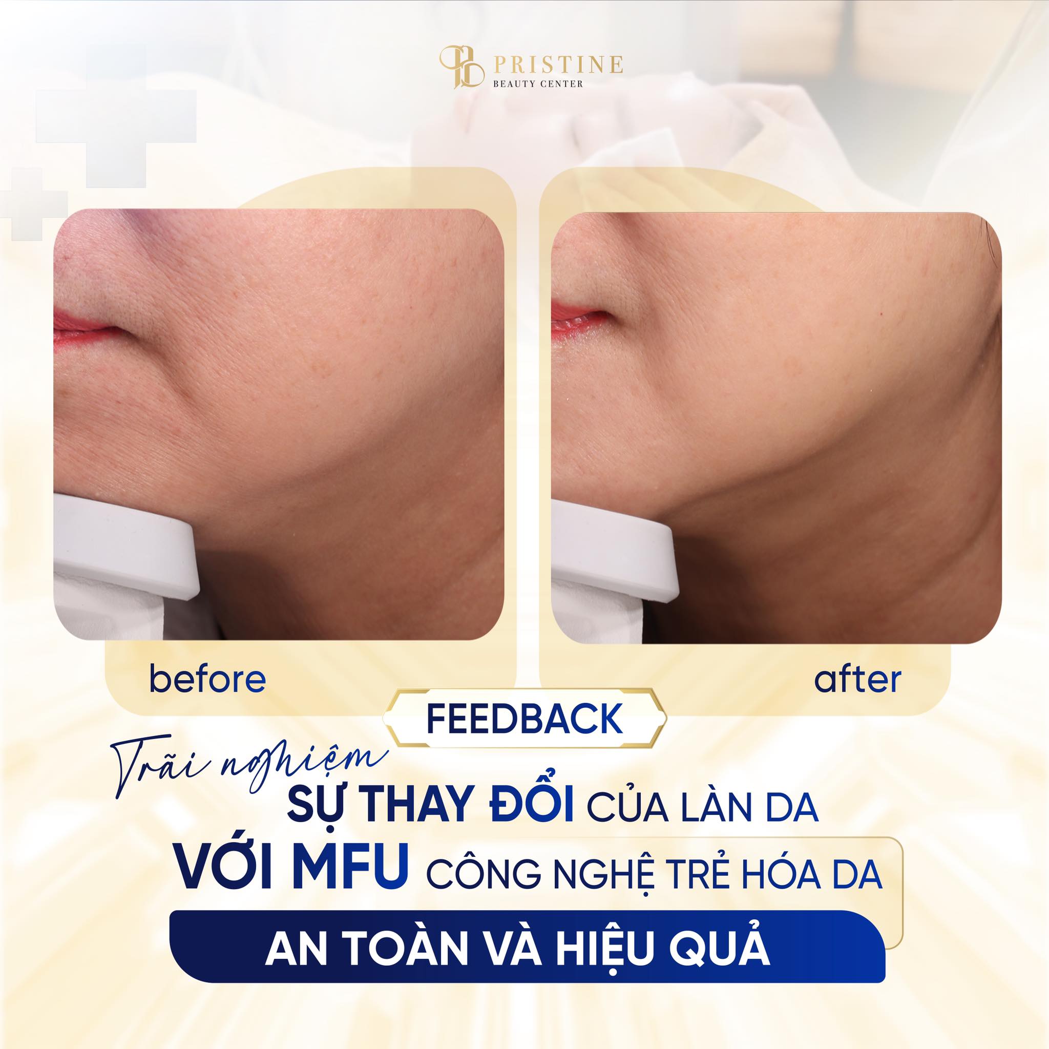 Trẻ hóa da không phẫu thuật với MFU - Công nghệ mới tại Pristine 3 tre-hoa-da-khong-xam-lan-mfu