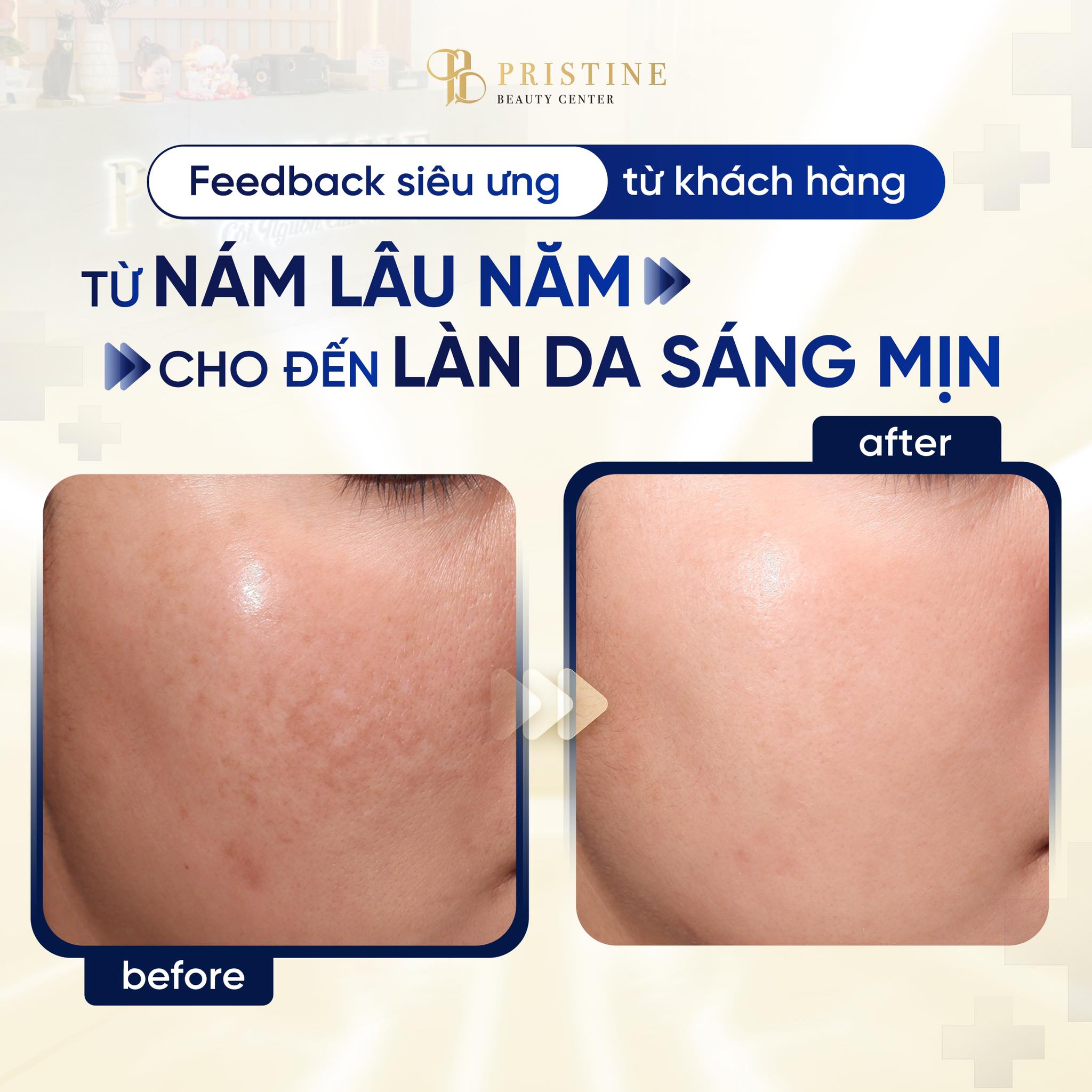 Nám nội tiết – “kẻ thù” thầm lặng của phụ nữ sau 30 2 Feedback điều trị nám tại trung tâm Pristine Beauty Center