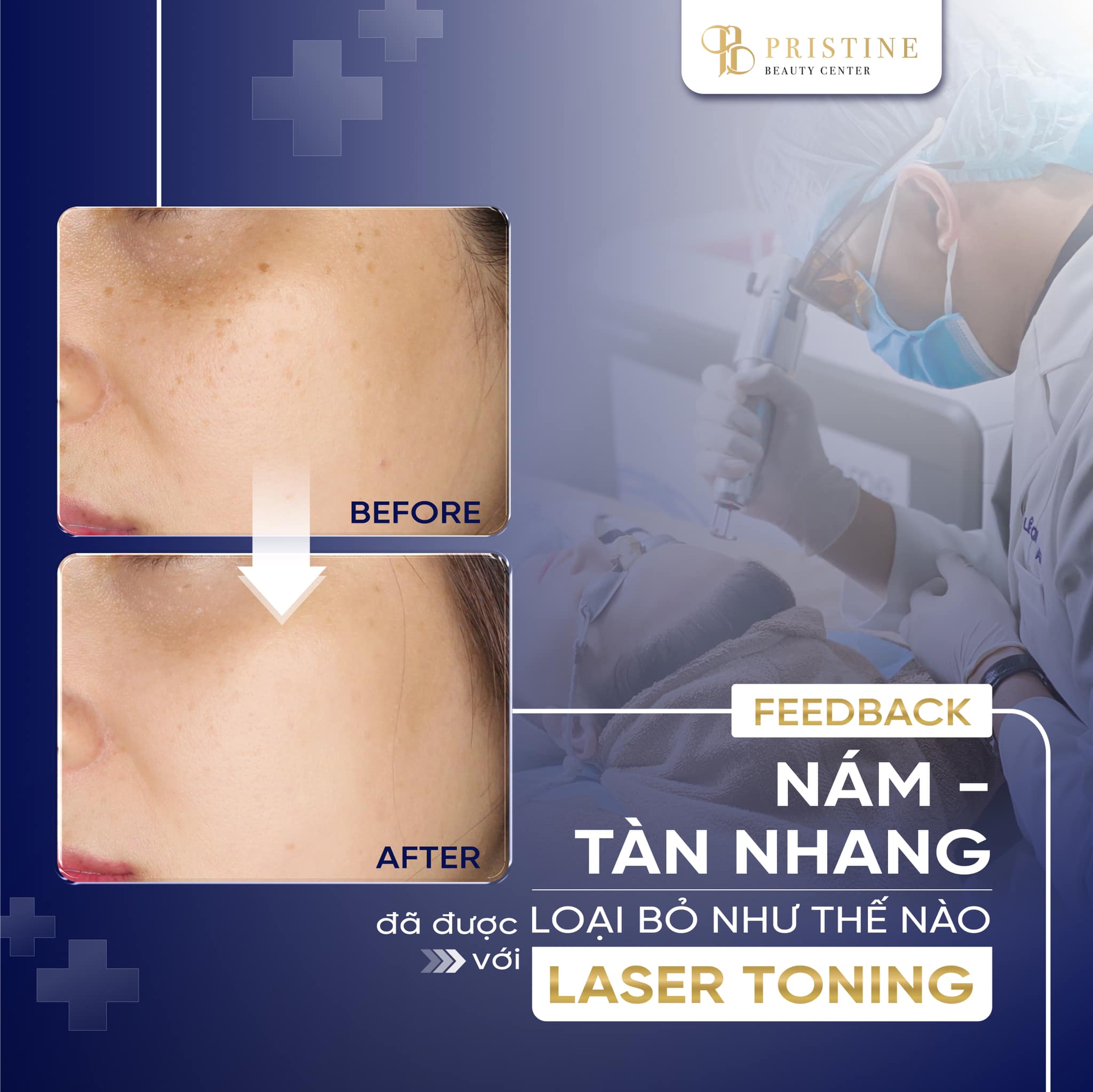 Nám nội tiết – “kẻ thù” thầm lặng của phụ nữ sau 30 4 Laser Toning điều trị tình trạng nám nội tiết hiệu quả