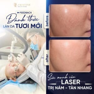 Laser Pico Discovery – Đột phá trong điều trị nám & tàn nhang