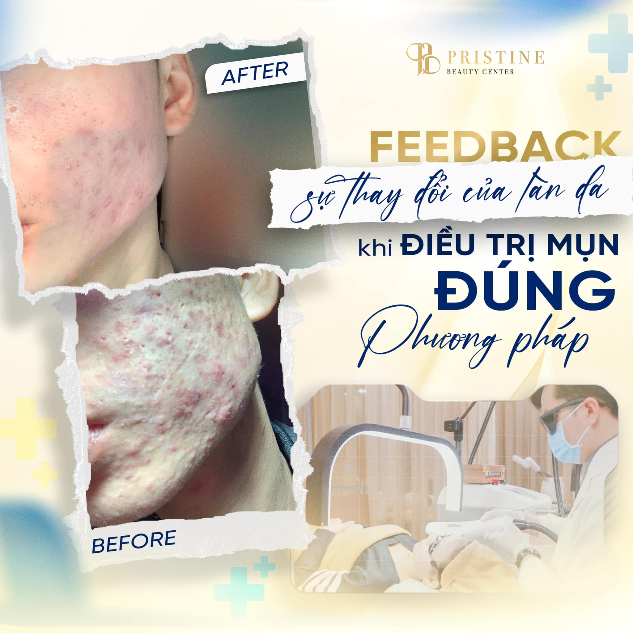 Lợi ích của công nghệ Laser Long Pulse