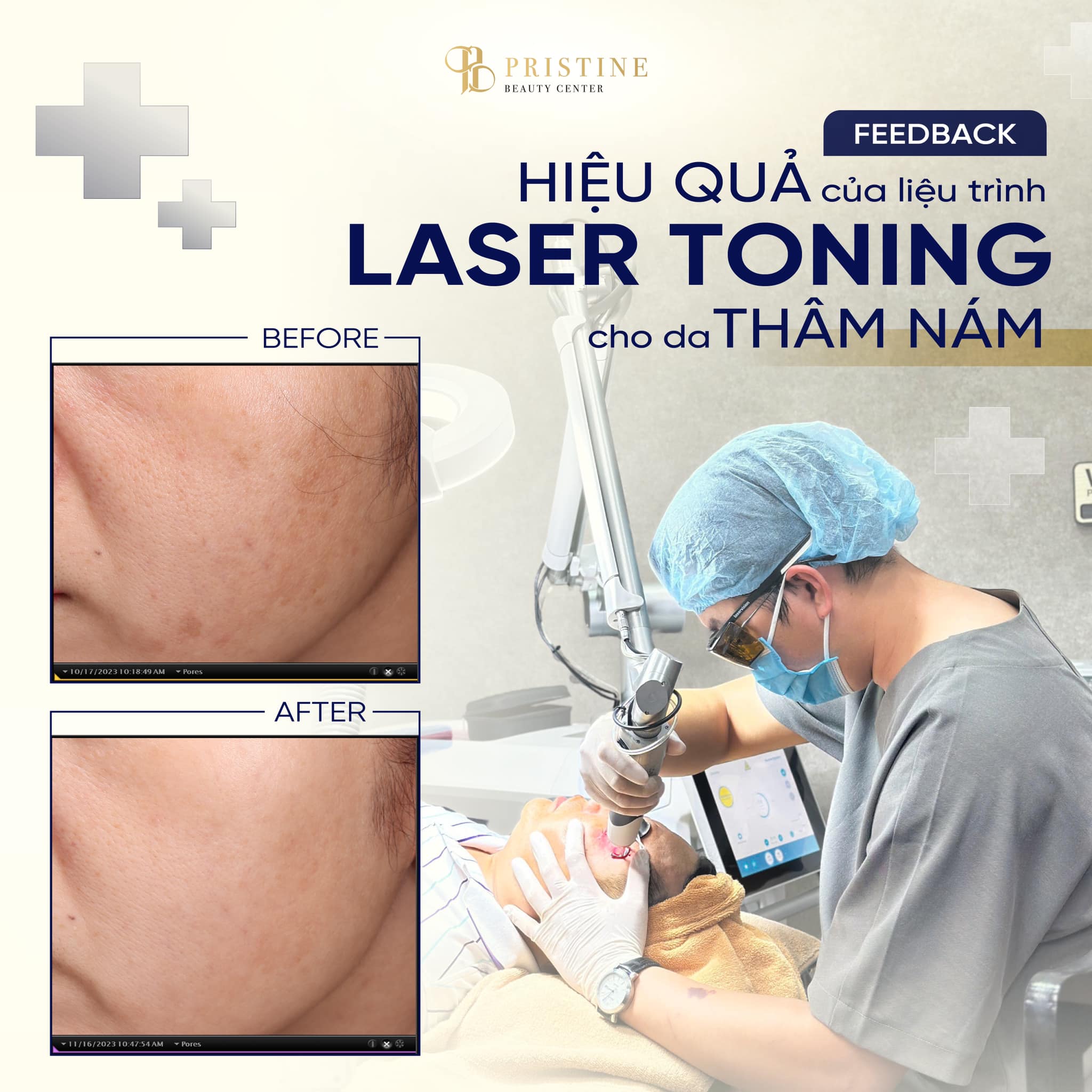 Nám nội tiết – “kẻ thù” thầm lặng của phụ nữ sau 30 3 Laser Toning điều trị nám da được ưa chuộng hiện nay