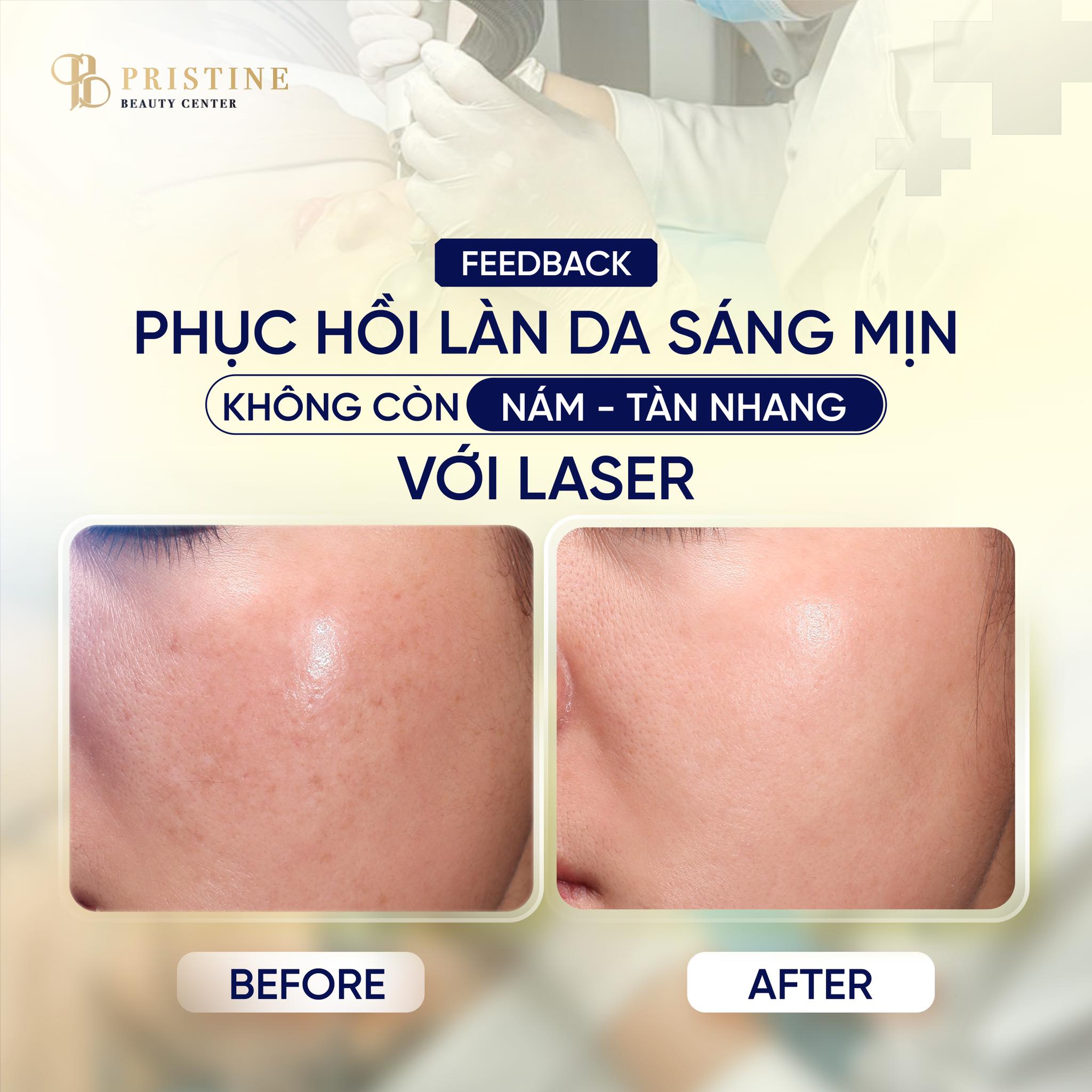 Discovery Pico Toning - Làn da sáng bật tone chỉ sau 1 liệu trình 2 Mang đến làn da rạng rỡ, lấy lại nét đẹp thanh xuân