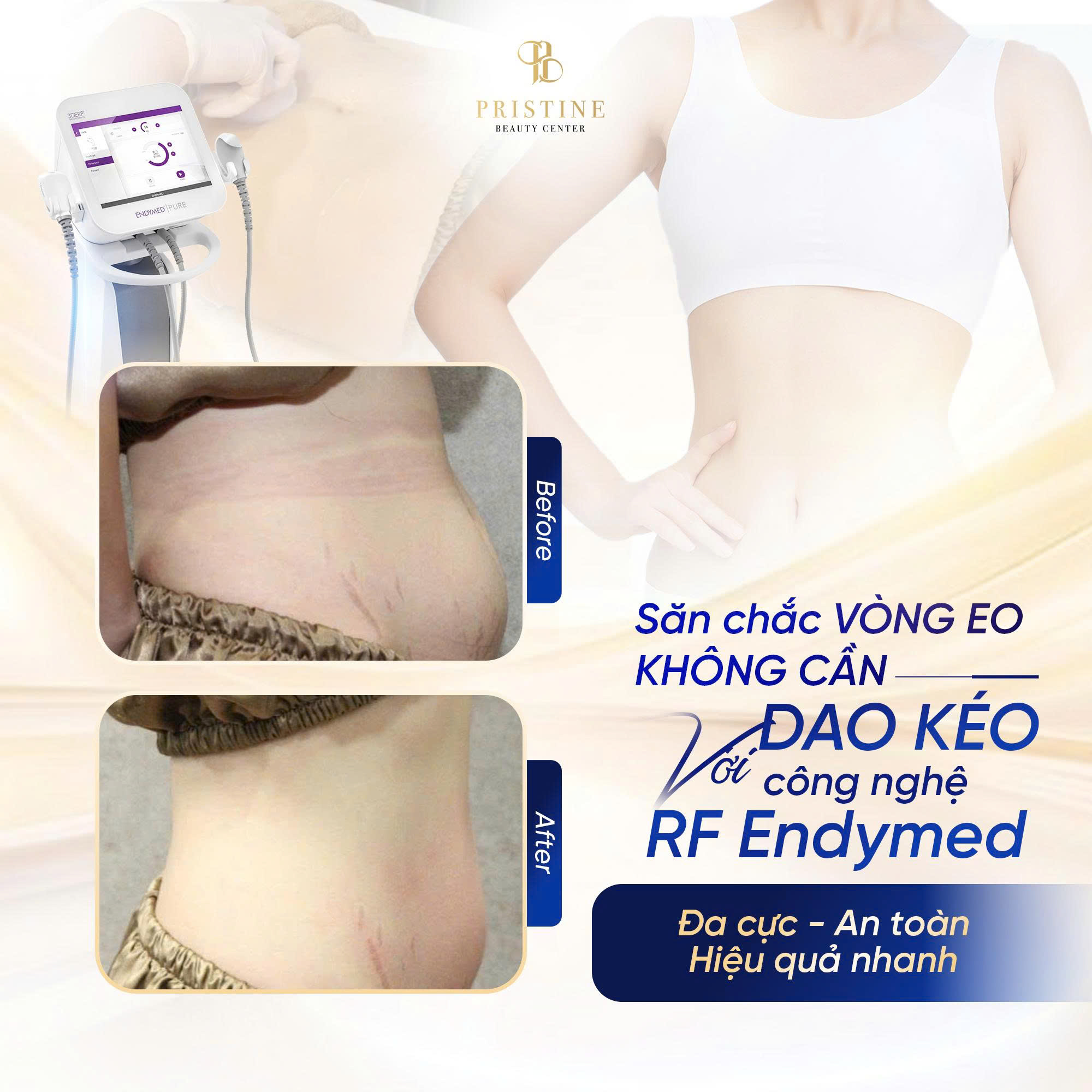 RF Endymed – Công nghệ RF 3DEEP tiên tiến giúp săn da, giảm mỡ hiệu quả 4 Feedback giảm mỡ của khách hàng tại Pristine Beauty Center