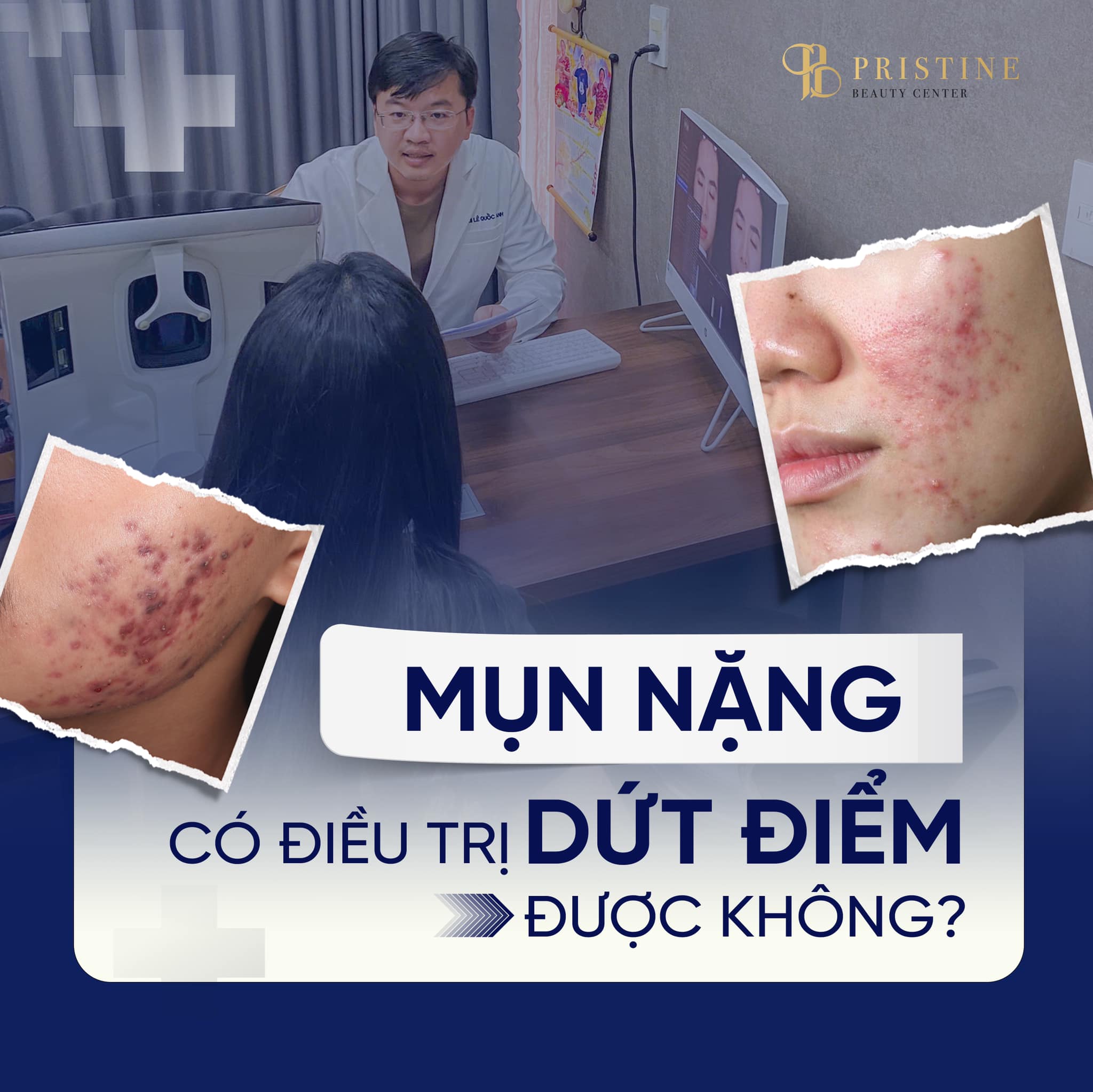 Nguyên nhân gây mụn viêm, mụn bọc