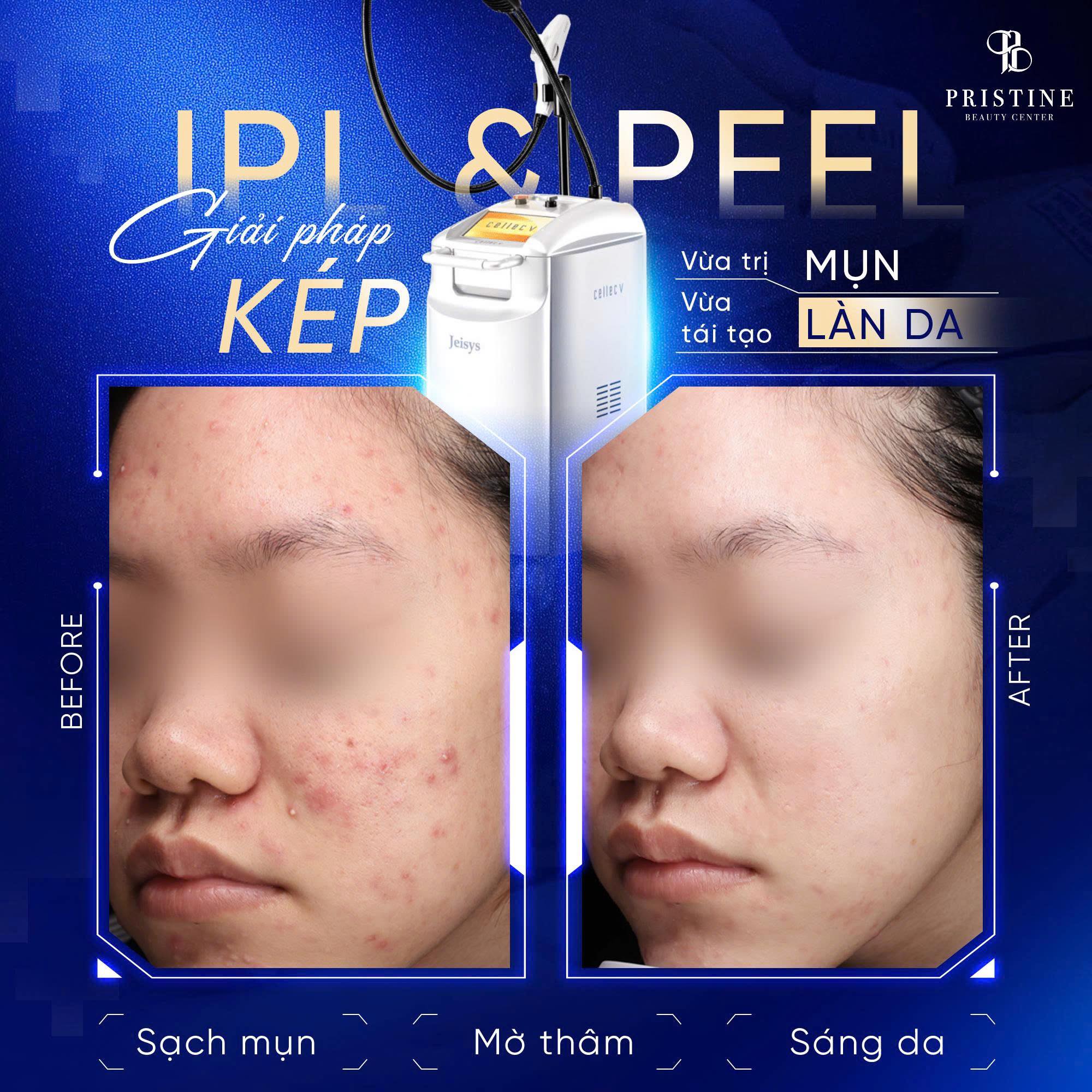 Điều trị mụn viêm tại phòng khám Da liễu Pristien Beauty Center