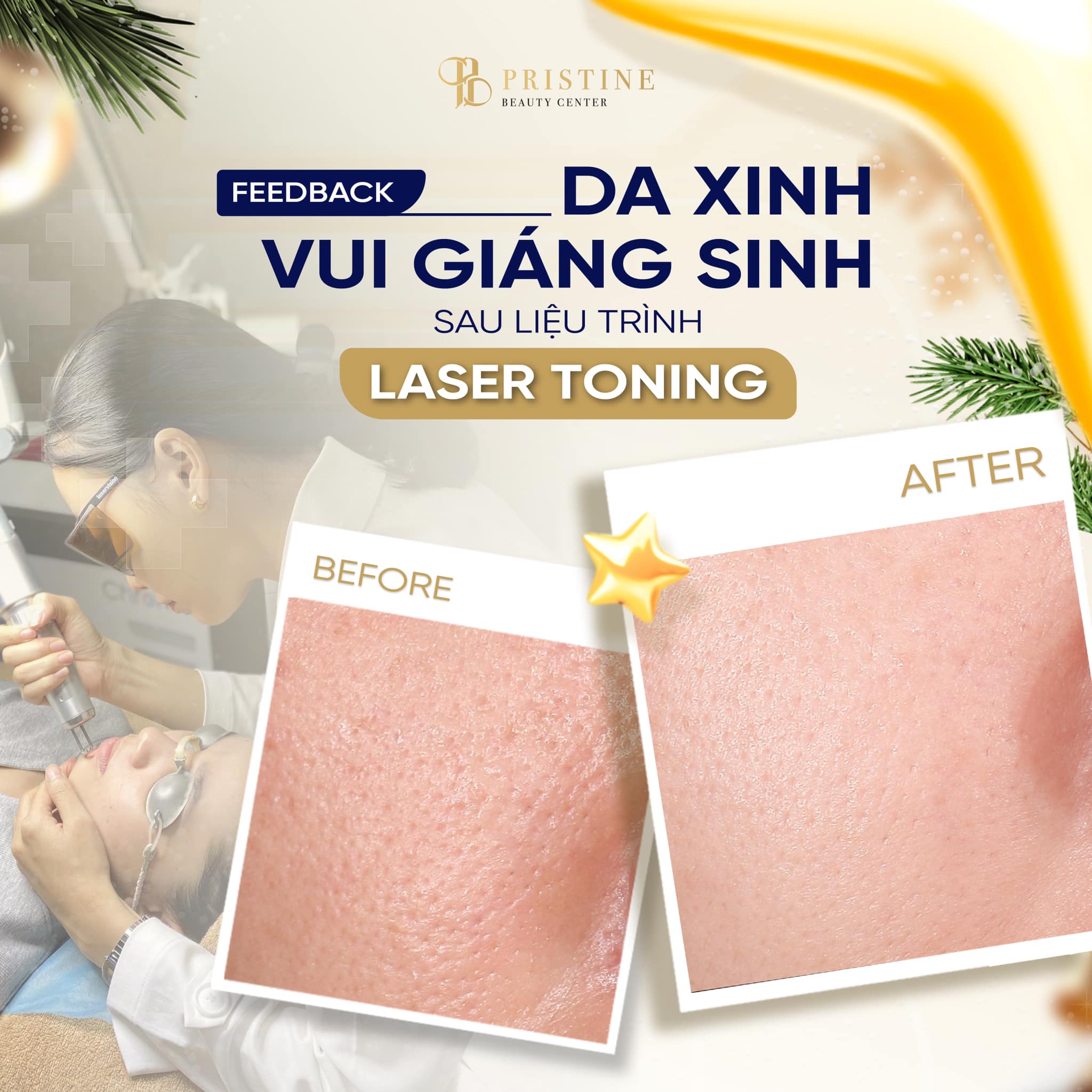 Laser Carbon Toning tại Pristine Beauty Center