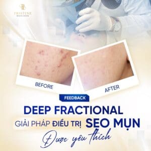 Pico Deep Fractional – Công nghệ Fractional thế hệ mới cho da thâm – rỗ – sẹo