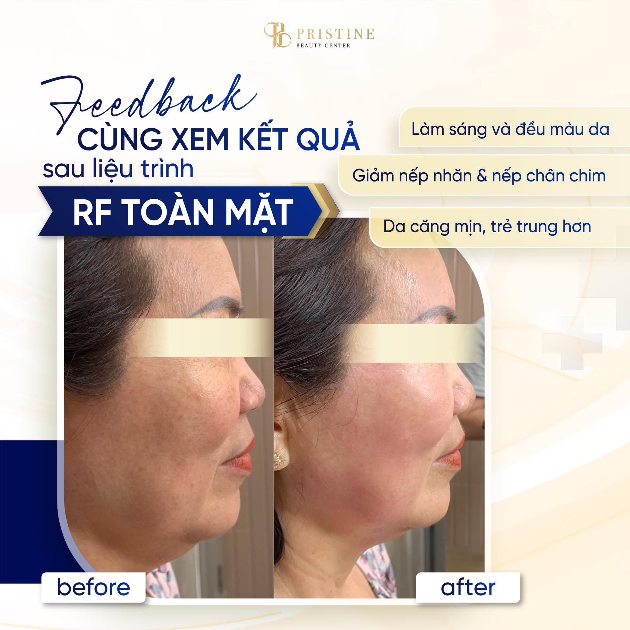 Gói MidFace 2026 – Quy trình nâng rãnh má chuẩn y khoa 4 RF kích thích các tế bào sợi sản sinh Collagen và Elastin