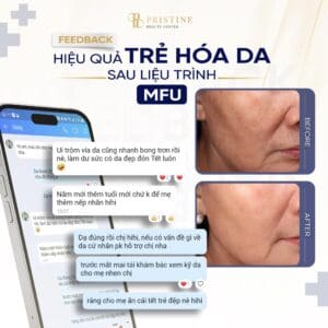 Gói midface 2026 tại Phòng khám Da liễu Biên Hoà Pristine