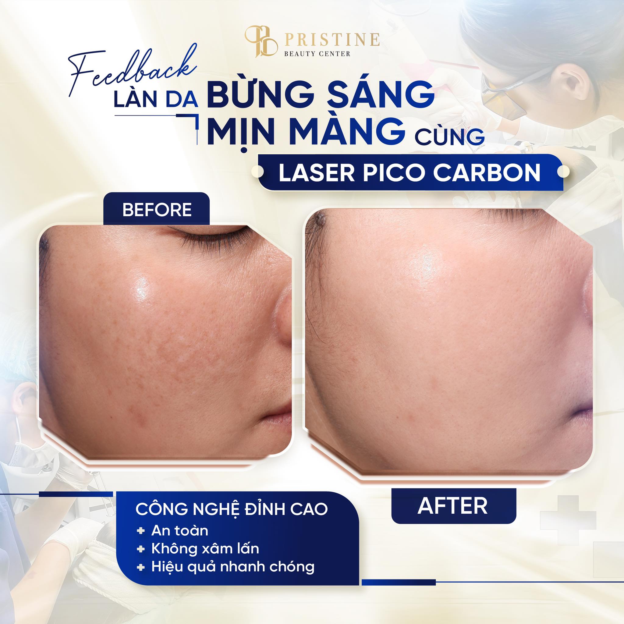Gói MidFace 2026 – Quy trình nâng rãnh má chuẩn y khoa 5 Laser Pico Carbon giúp làn da bừng sáng
