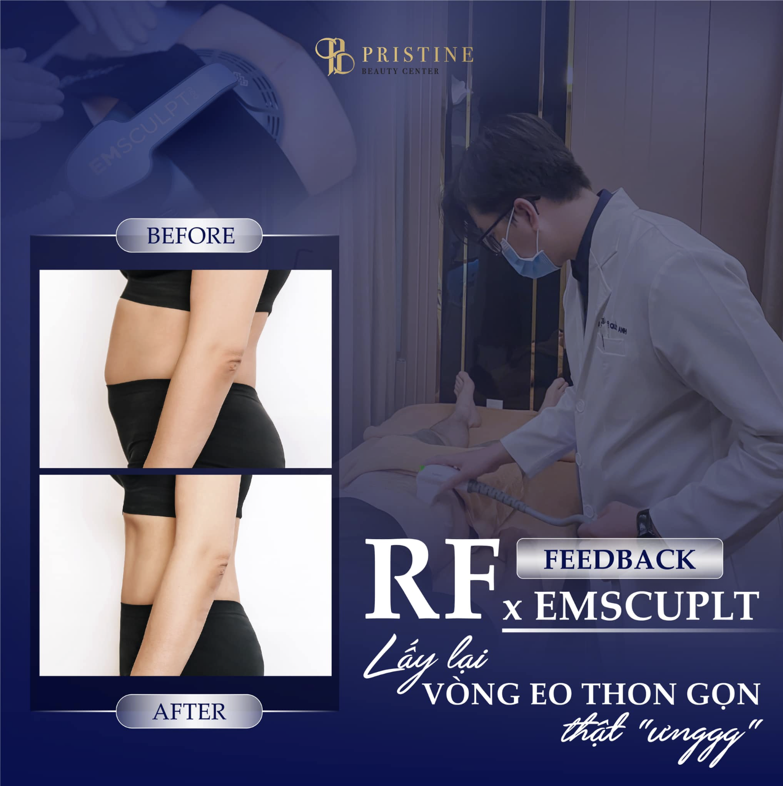 Sự kết hợp giữa RF Body và Emsculpt