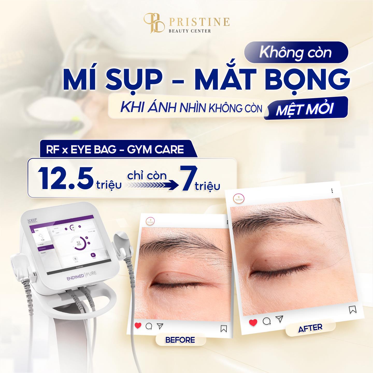 RF mắt có an toàn không? Giải pháp cải thiện mí sụp không xâm lấn tại Biên Hoà 2 Công nghệ RF tại Pristine tác động nhẹ nhàng, không xâm lấn, cải thiện vùng mắt an toàn, rõ rệt
