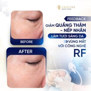 Khách hàng Pristine cảm nhận bọng mắt giảm, mí gọn hơn, ánh nhìn linh hoạt chỉ sau vài buổi