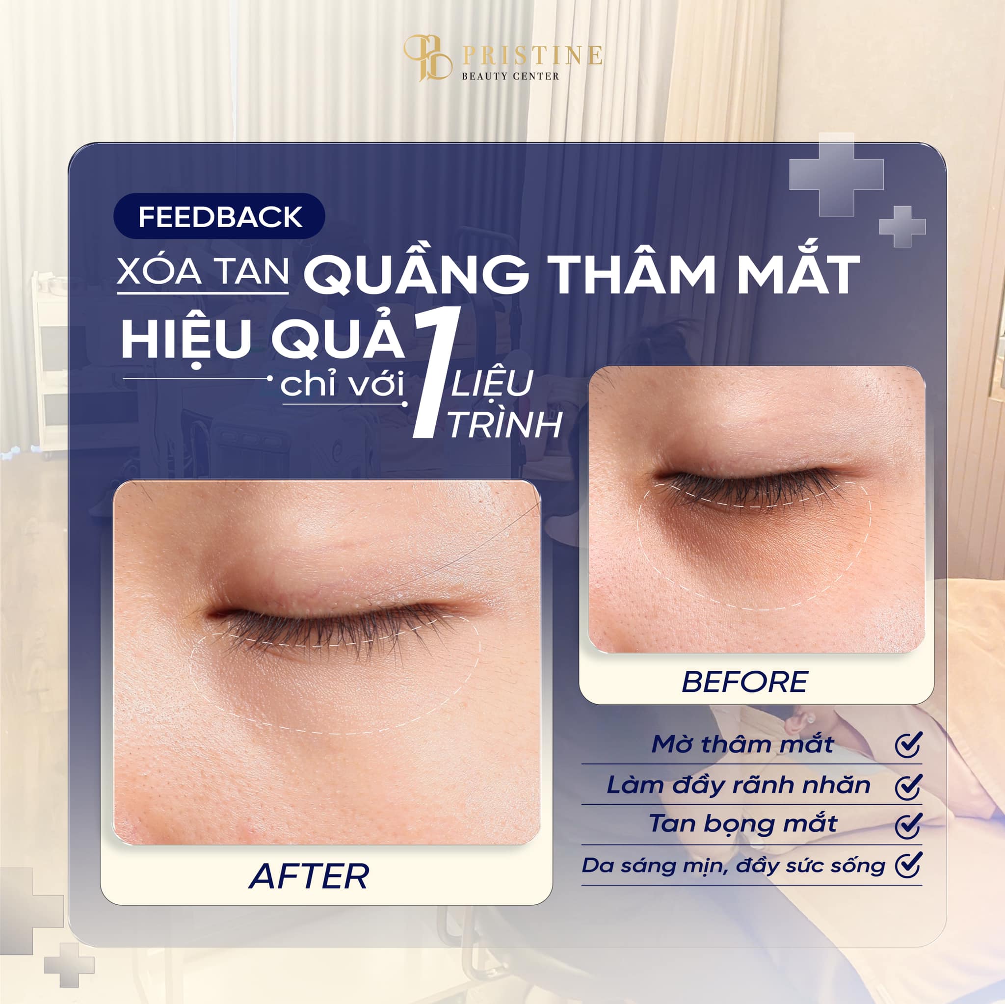 Trẻ hóa mắt không phẫu thuật - Giải cứu mí sụp, mắt bọng tại Pristine Beauty Center 6 Cam kết kết quả rõ rệt theo đúng lộ trình