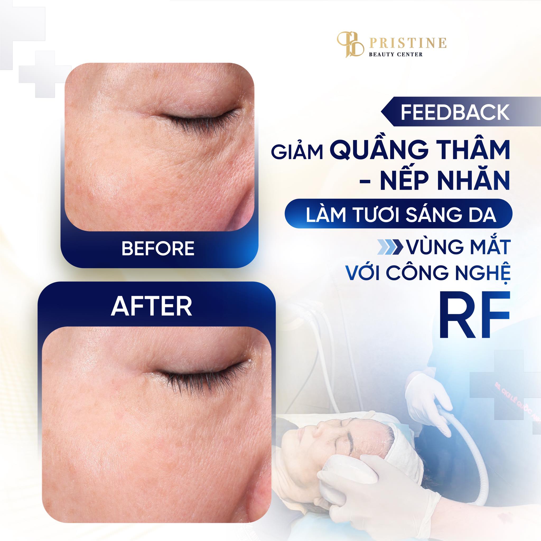 Trẻ hóa mắt không phẫu thuật - Giải cứu mí sụp, mắt bọng tại Pristine Beauty Center 3 Công nghệ RF Mắt - Nâng mí, xóa nhăn hiệu quả