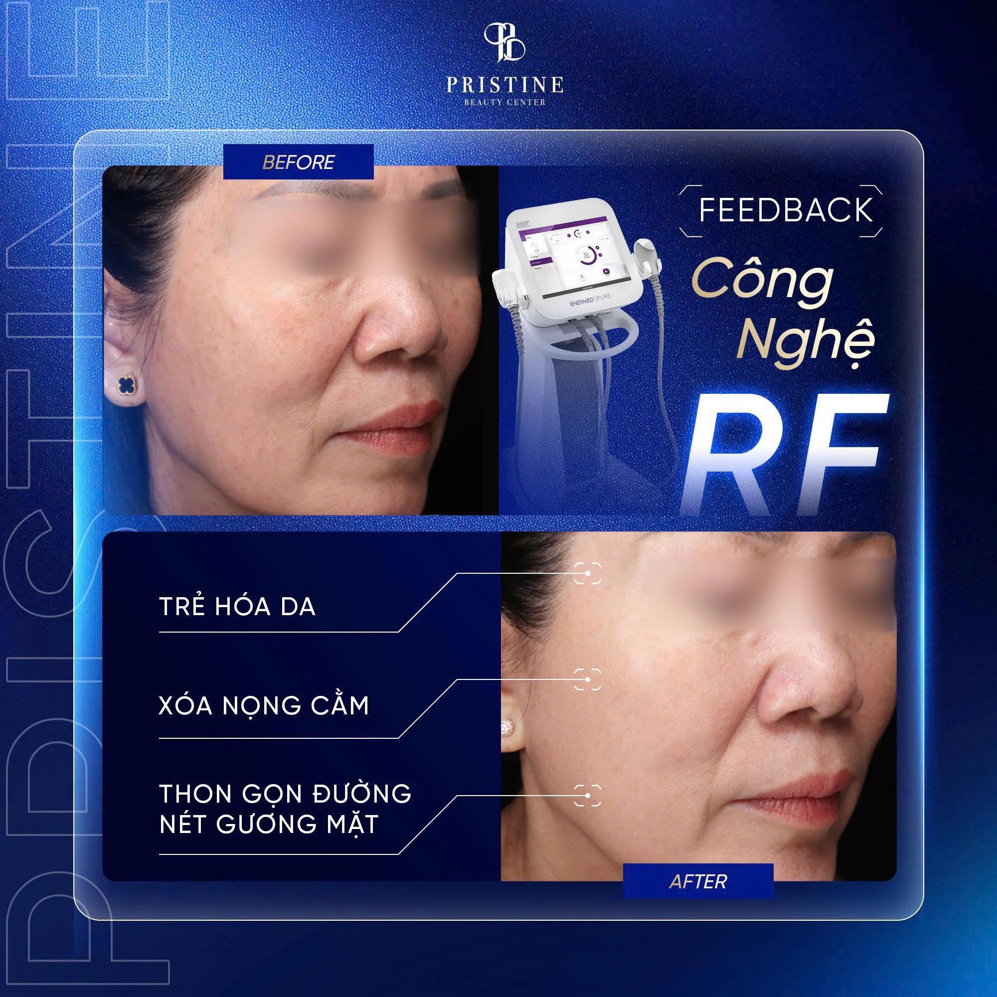 RF giúp làm săn chắc da vùng cằm và viền hàm một cách nhẹ nhàng