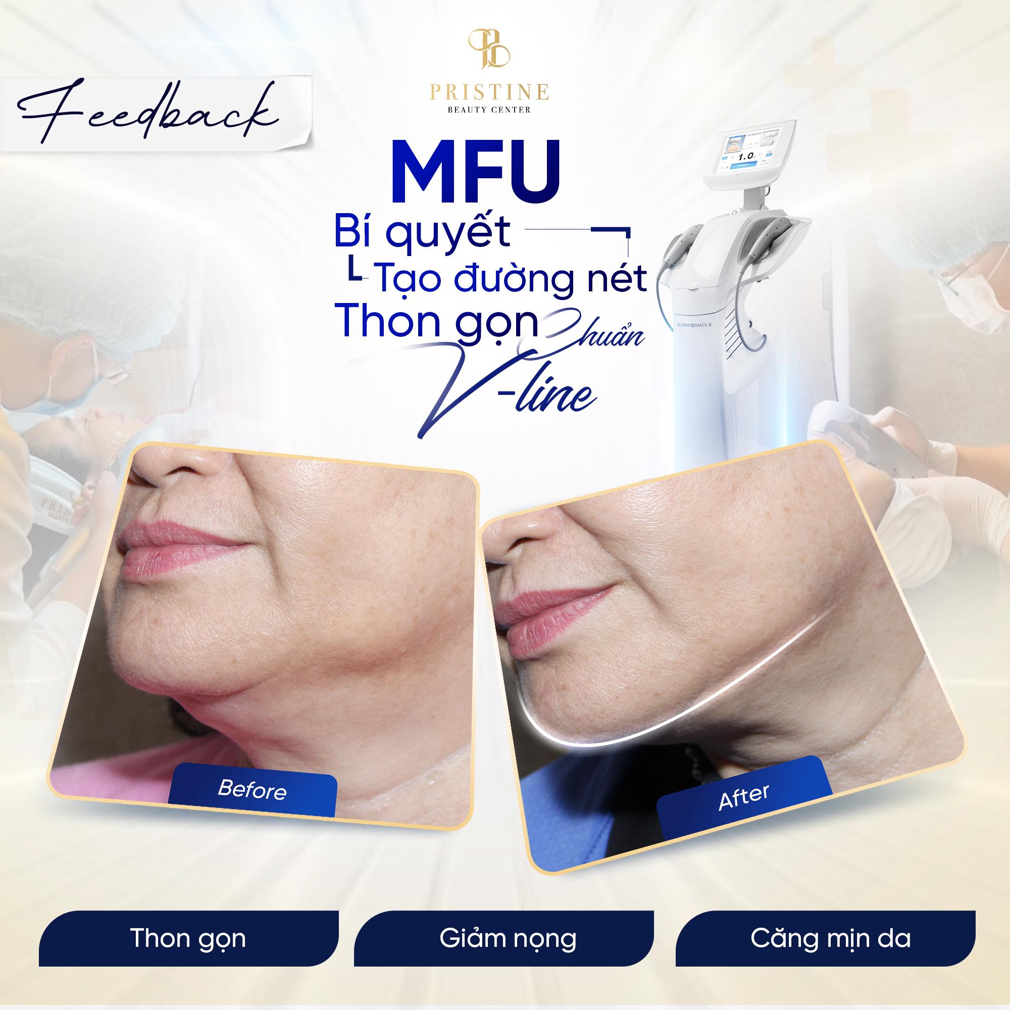 MFU nâng kéo vùng da chảy xệ, giúp đường viền hàm trở nên sắc nét