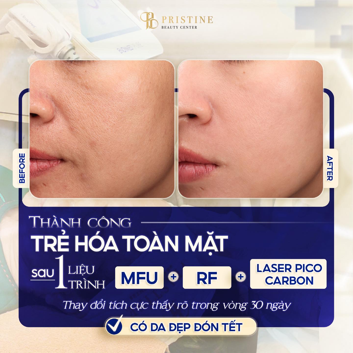 Hiệu quả trẻ hoá toàn mặt từ So sánh Ultraformer MPT