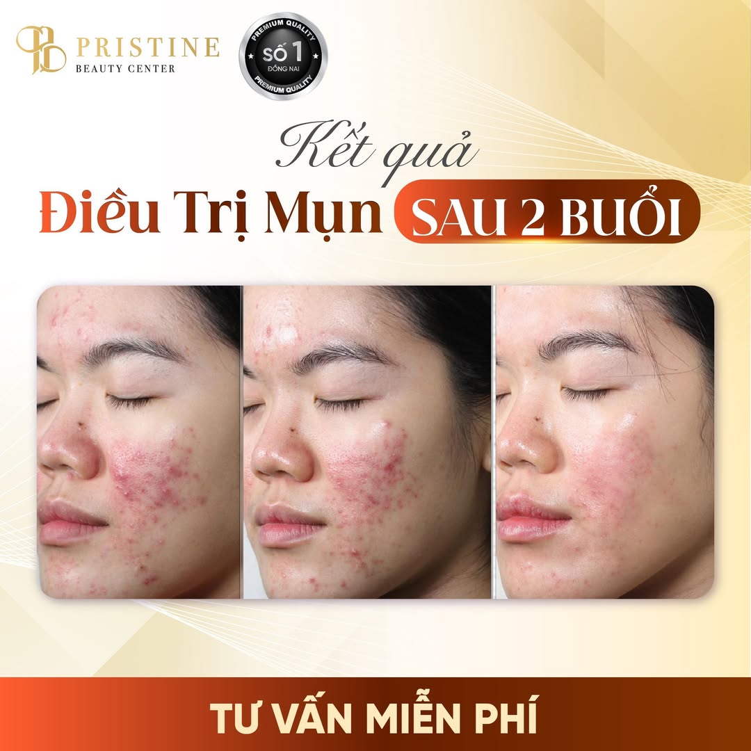 Phác đồ điều trị mụn tại Pristine Beauty Center