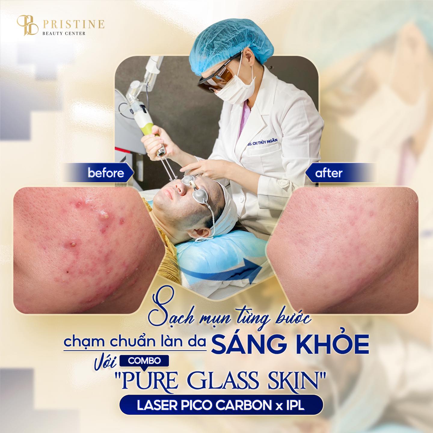Điều trị mụn Công nghệ cao tại Biên Hòa: Top các phương pháp hiệu quả nhất hiện nay 2 Laser Pico trong điều trị thâm mụn