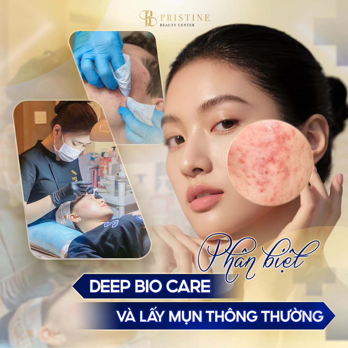 Điều trị mụn Công nghệ cao tại Biên Hòa: Top các phương pháp hiệu quả nhất hiện nay 4 Xử lý nhân mụn với DEEP BIO CARE tại Pristine Beauty Center