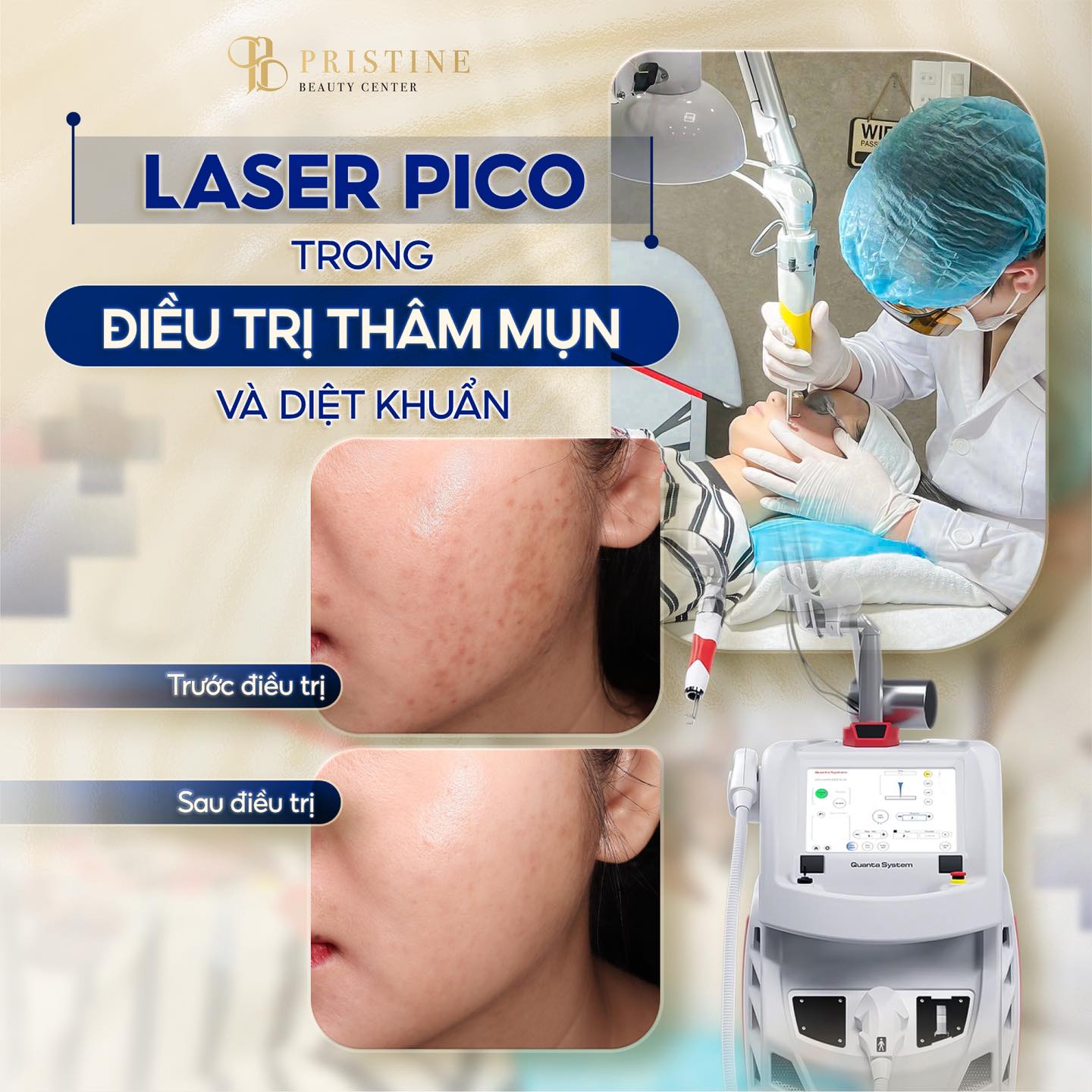Điều trị mụn Công nghệ cao tại Biên Hòa: Top các phương pháp hiệu quả nhất hiện nay 8 Điều trị mụn Công nghệ cao Biên Hòa