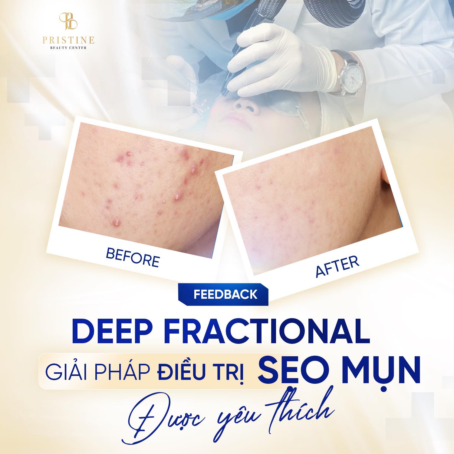 Điều trị mụn nội tiết tái phát nhiều lần gây sẹo