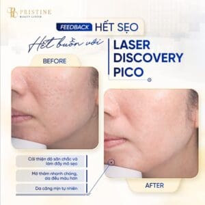 Feedback điều trị sẹo mụn bằng Laser Discover Pico