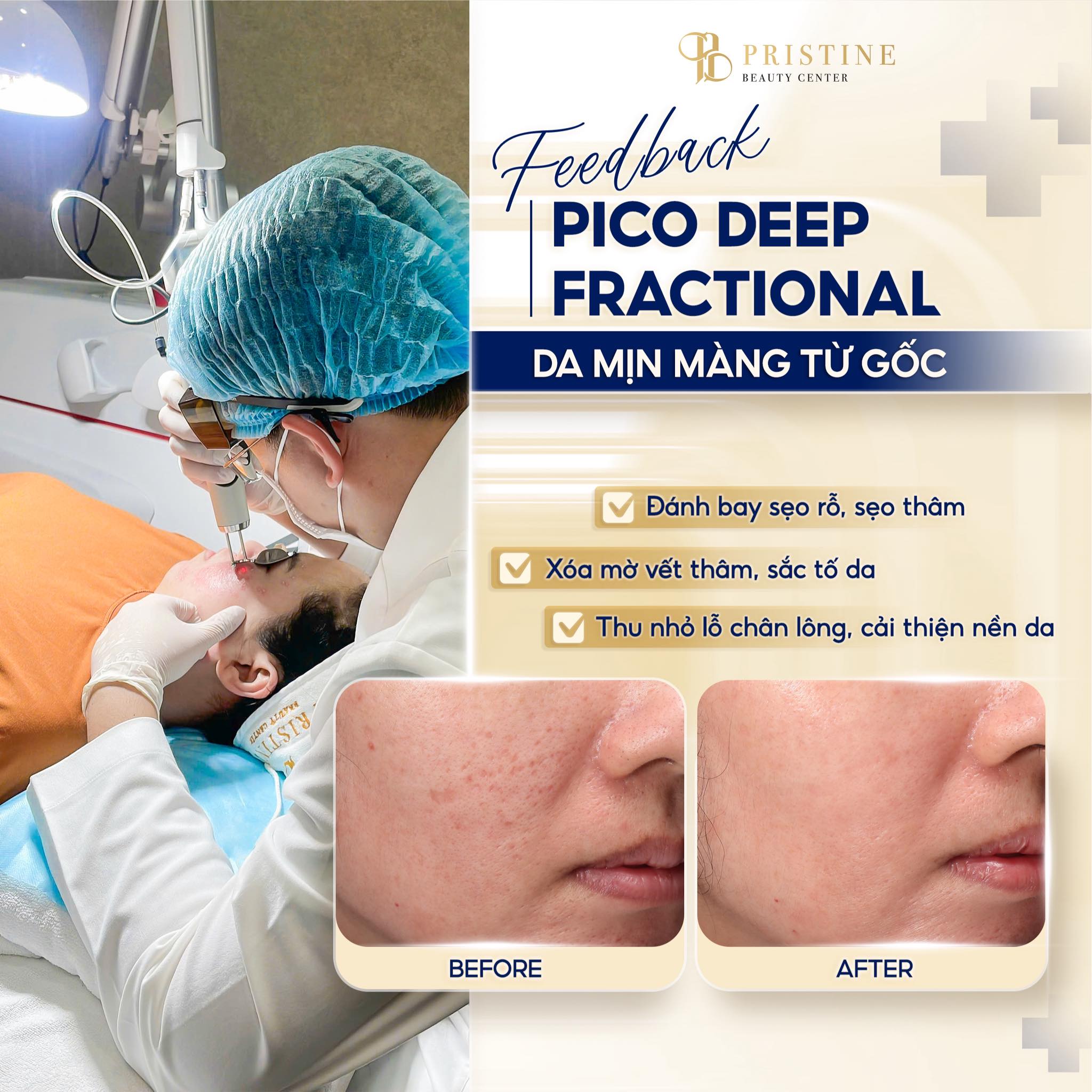 Sẹo mụn có tự hết không - Kết quả điều trị sau 1 liệu trình Pico Deep Fractional