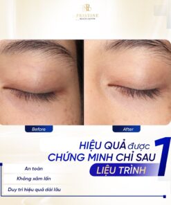 Khắc phục tình trạng da mắt chùng nhão, xuất hiện quầng thâm