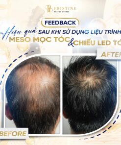 Hình ảnh điều trị thực tế tại phòng khám chuyên khoa Da liễu Biên Hoà