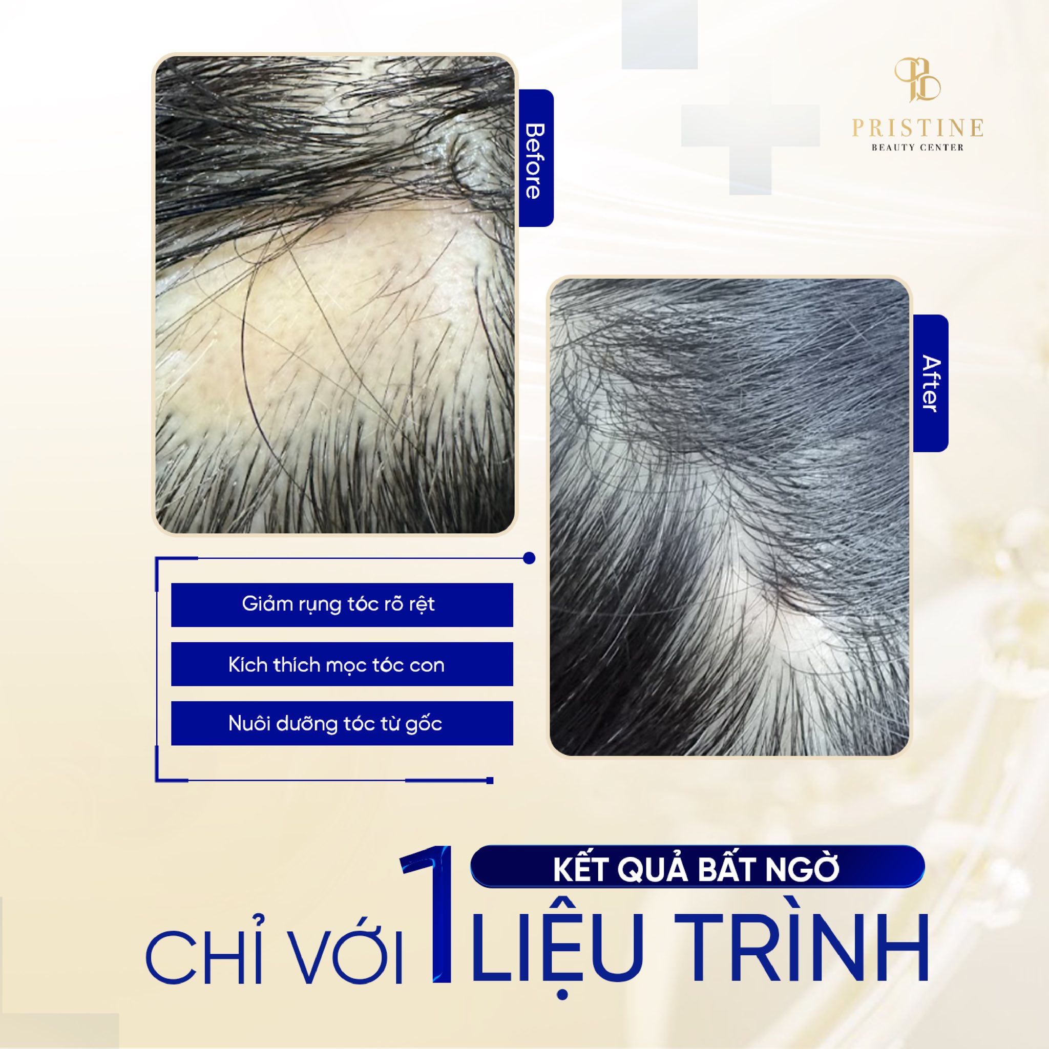 Meso mọc tóc 6 Kết quả điều trị meso tóc sau 1 liệu trình