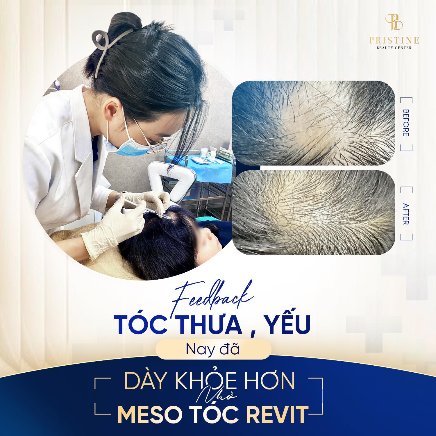 Meso mọc tóc 2 Meso tóc REVIT tại phòng khám chuyên khoa Da liễu Biên Hoà