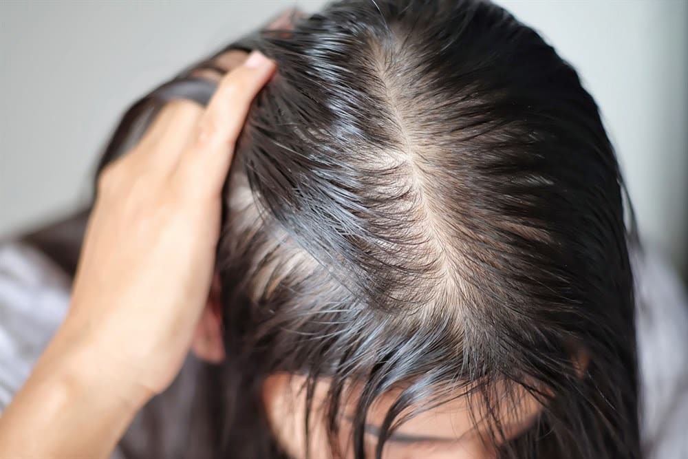 Tình trạng tóc thưa, mỏng, nền da đầu yếu