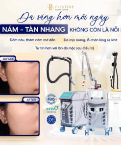 PC nám má 2 Công nghệ điều trị nám thế hệ mới hàng đầu tại Đồng Nai