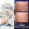 Kết quả sau liệu trình trị nám của khách hàng tại phòng khám Da liễu Biên Hoà