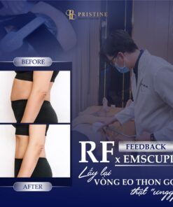 RF săn chắc da, giảm mỡ bụng hiệu quả sau 1 liệu trình