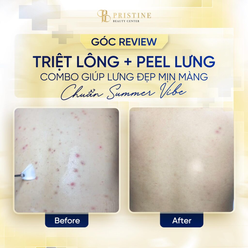Triệt lông Laser có vĩnh viễn không? Sự thật từ chuyên gia da liễu 1 Feedback triệt lông vùng lưng của khách hàng tại Pristine Beauty Center