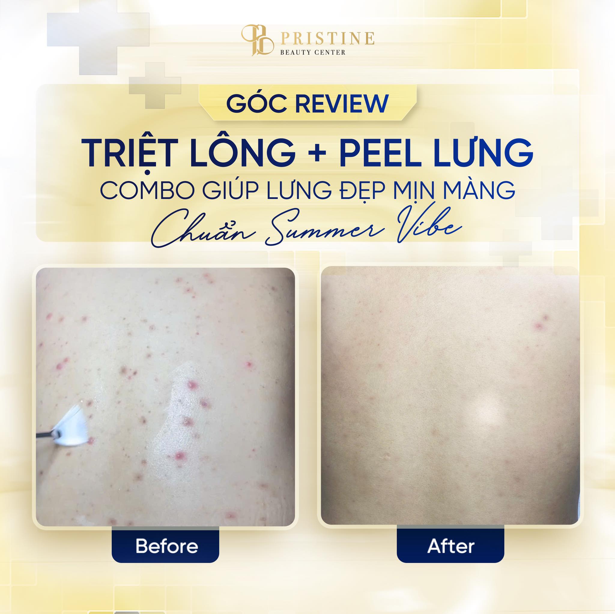 Triệt lông Laser có vĩnh viễn không? Sự thật từ chuyên gia da liễu 3 Feedback triệt lông vùng lưng của khách hàng tại Pristine Beauty Center