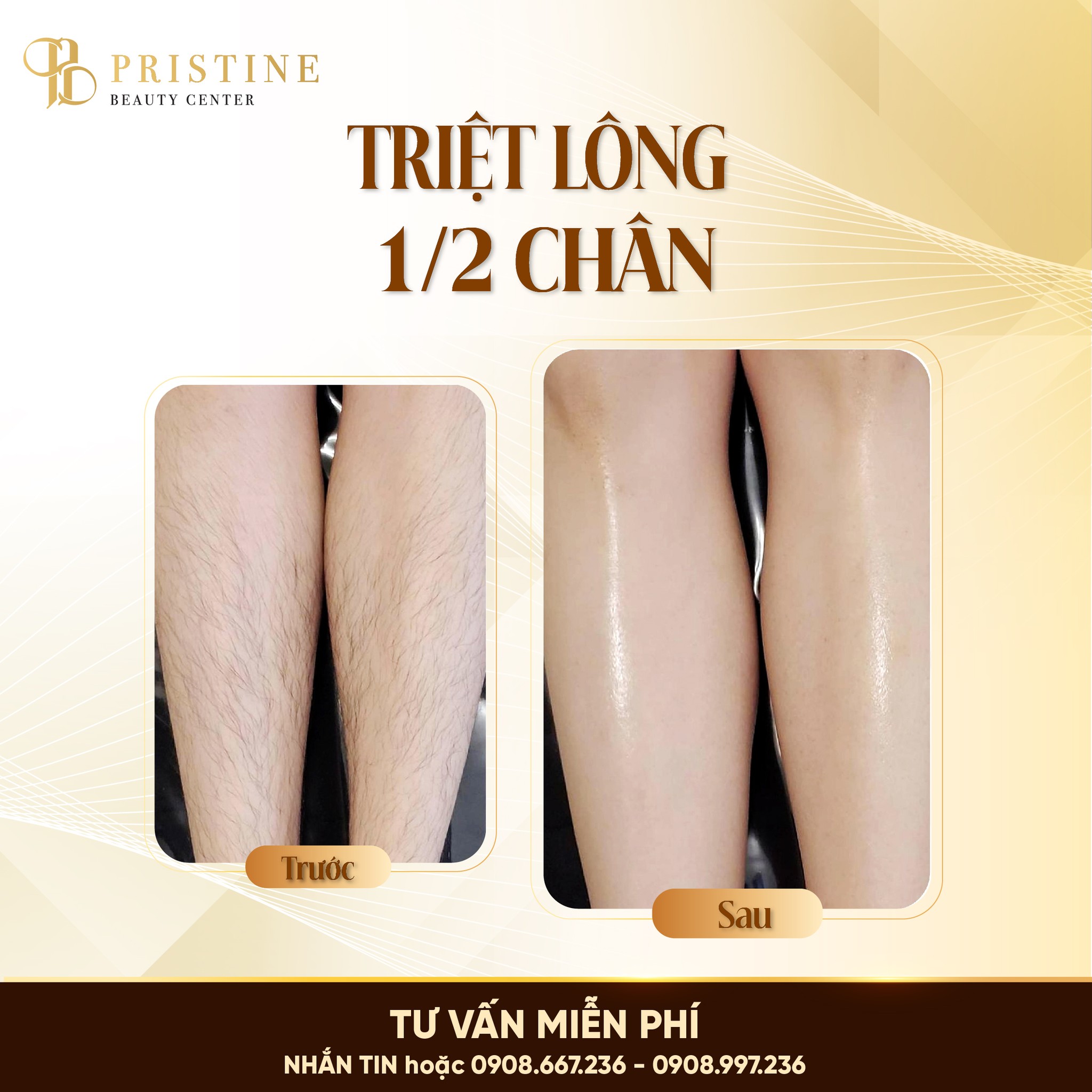 Triệt lông Laser có vĩnh viễn không? Sự thật từ chuyên gia da liễu 5 Quy trình triệt lông an toàn, phác đồ cá nhân hoá theo từng khách hàng