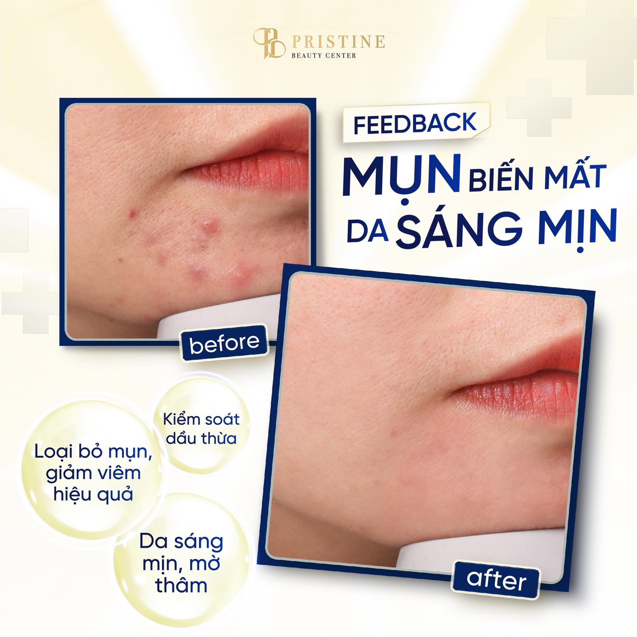 TRỊ MỤN CHUẨN Y KHOA THEO PHÁC ĐỒ CÁ NHÂN HÓA TỪ BÁC SĨ DA LIỄU