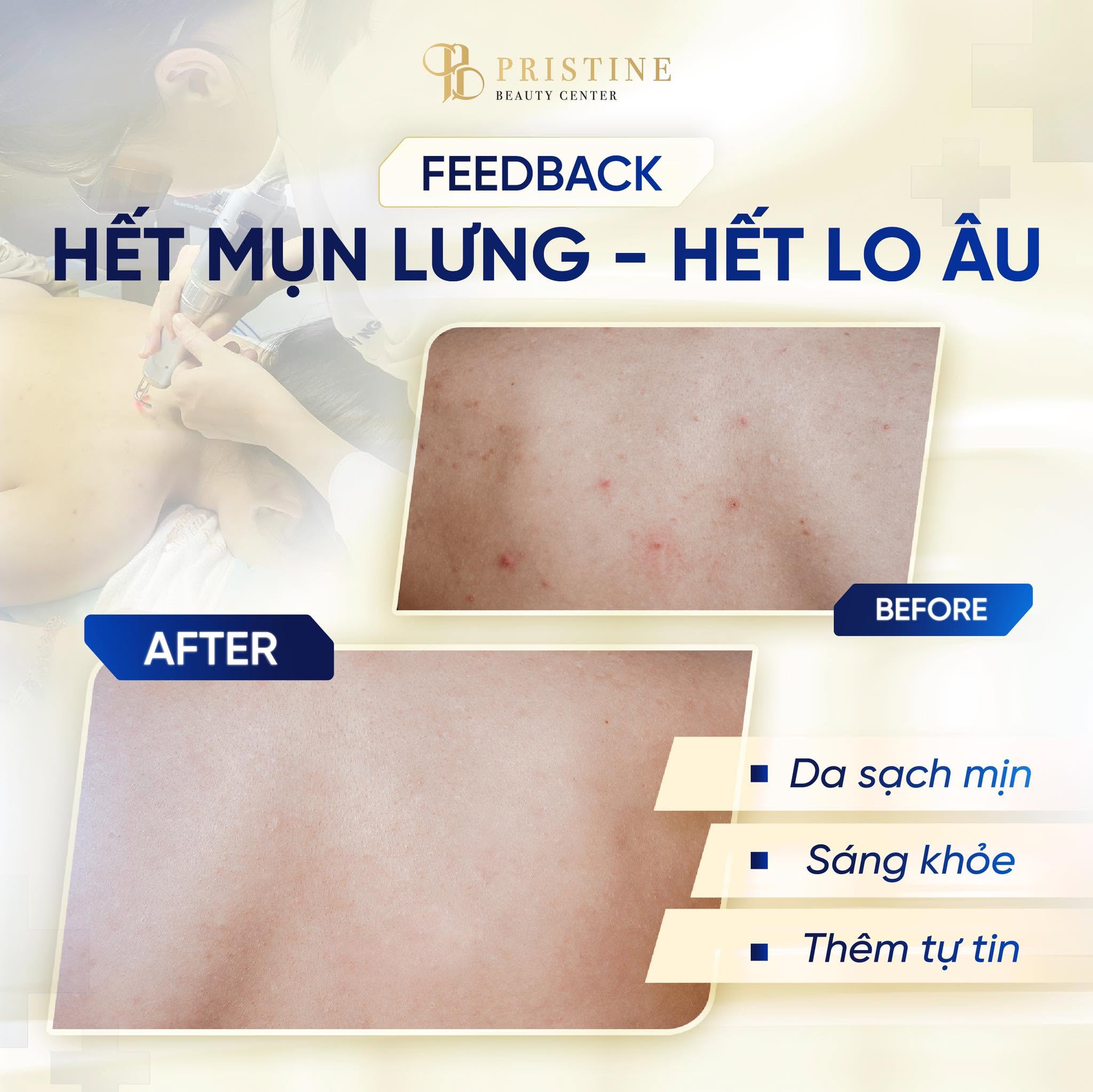 TRỊ MỤN CHUẨN Y KHOA THEO PHÁC ĐỒ CÁ NHÂN HÓA TỪ BÁC SĨ DA LIỄU