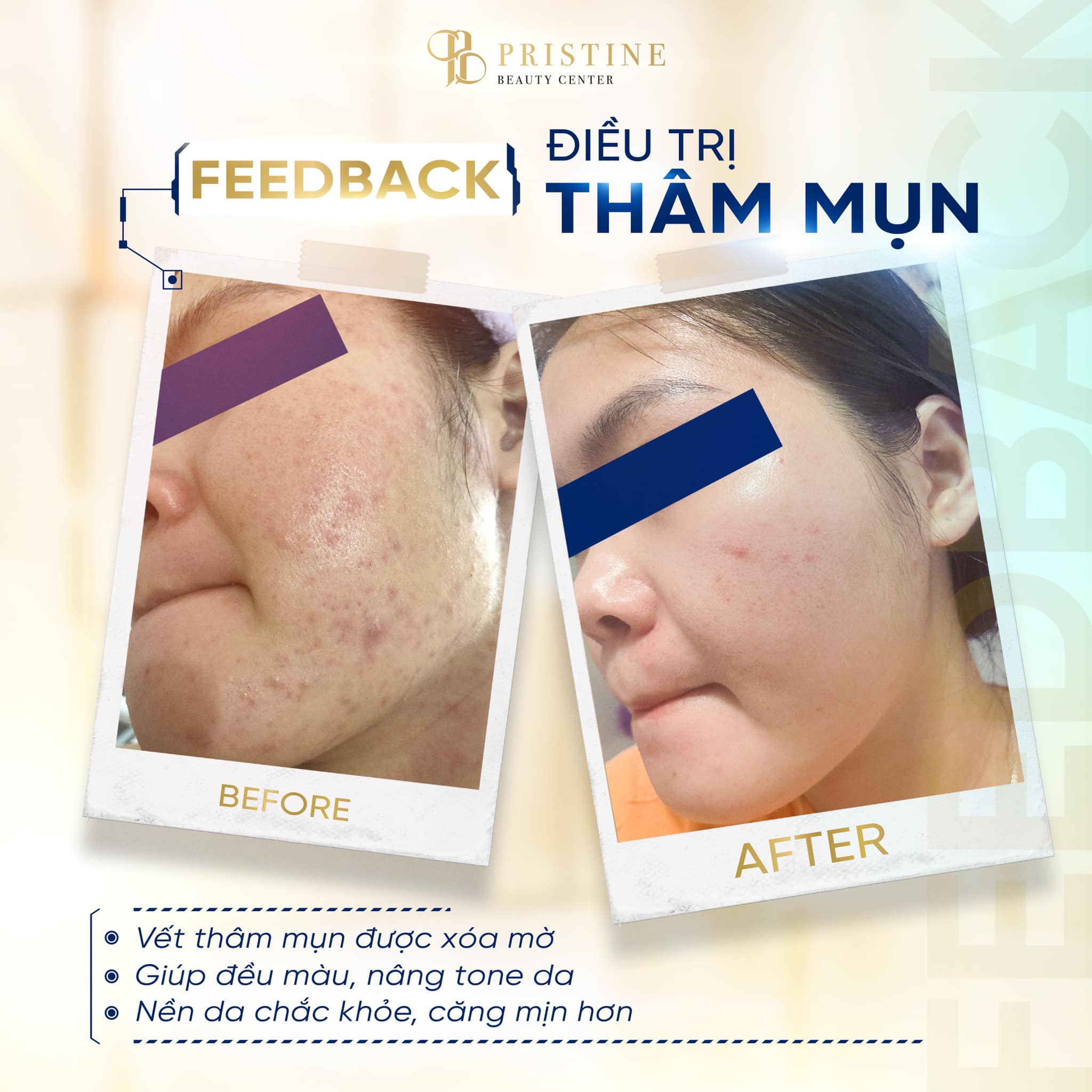 Bác Sĩ Trị Mụn Giỏi Tại Biên Hòa: Giải Pháp Chuẩn Y Khoa Tại Pristine Beauty Center 5 Hỗ trợ điều trị mụn ẩn, thâm mụn