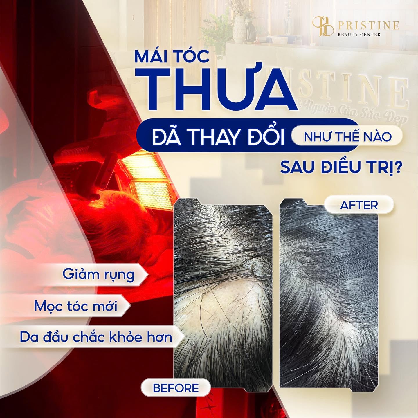 Hỗ trợ điều trị tóc thưa bẩm sinh, rụng tóc sau sinh, rụng tóc do stress