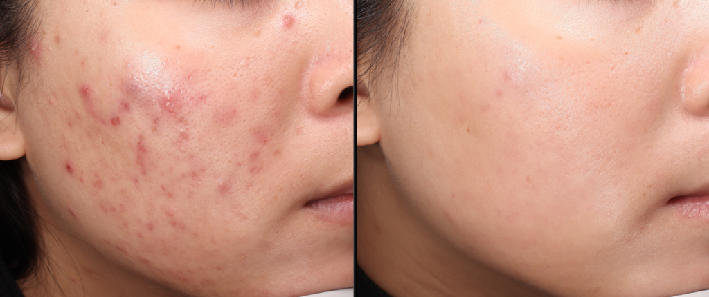 TRỊ MỤN CHUẨN Y KHOA THEO PHÁC ĐỒ CÁ NHÂN HÓA TỪ BÁC SĨ DA LIỄU