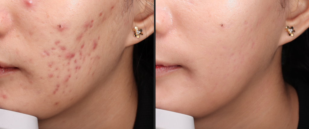 TRỊ MỤN CHUẨN Y KHOA THEO PHÁC ĐỒ CÁ NHÂN HÓA TỪ BÁC SĨ DA LIỄU