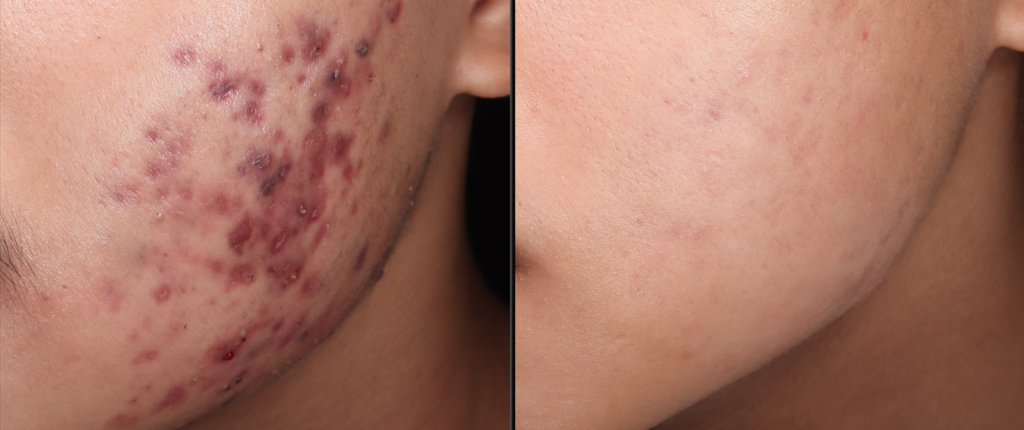 TRỊ MỤN CHUẨN Y KHOA THEO PHÁC ĐỒ CÁ NHÂN HÓA TỪ BÁC SĨ DA LIỄU