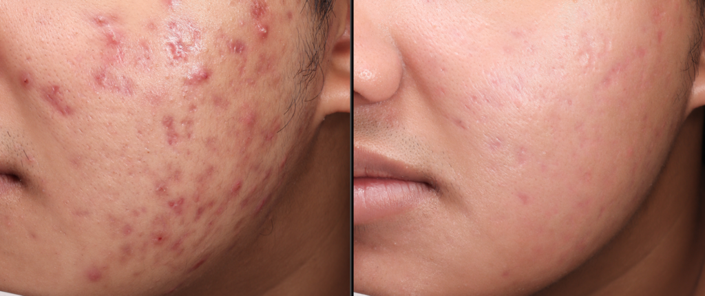 TRỊ MỤN CHUẨN Y KHOA THEO PHÁC ĐỒ CÁ NHÂN HÓA TỪ BÁC SĨ DA LIỄU